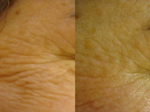 skincoach-before-after-011