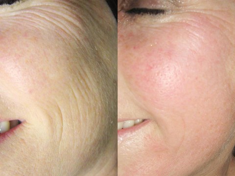 skincoach-before-after-021