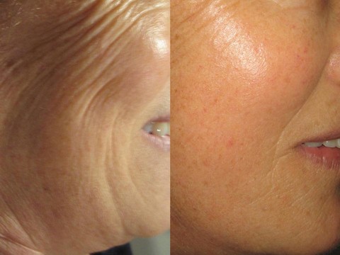 skincoach-before-after-041